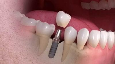 Dental Implants Katy Texas