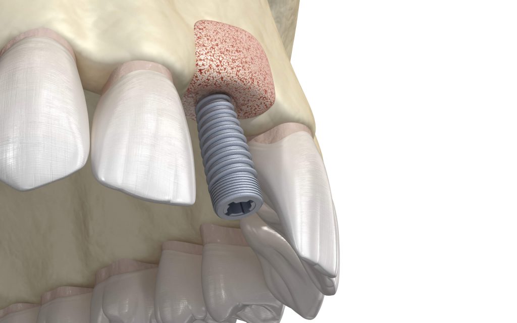 Dental Implants Montrose