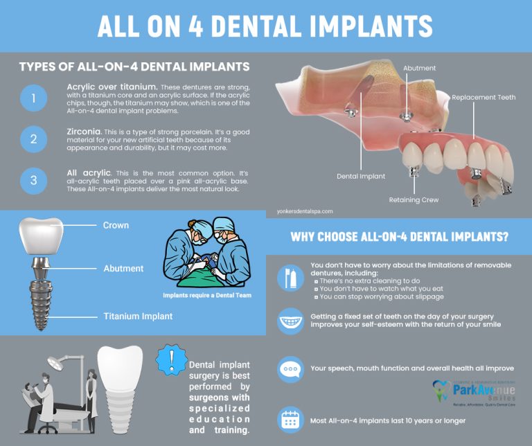 All On 4 Dental Implants 768x644