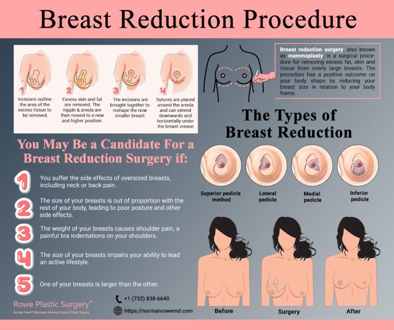 Breast Reduction Procedure 768x643