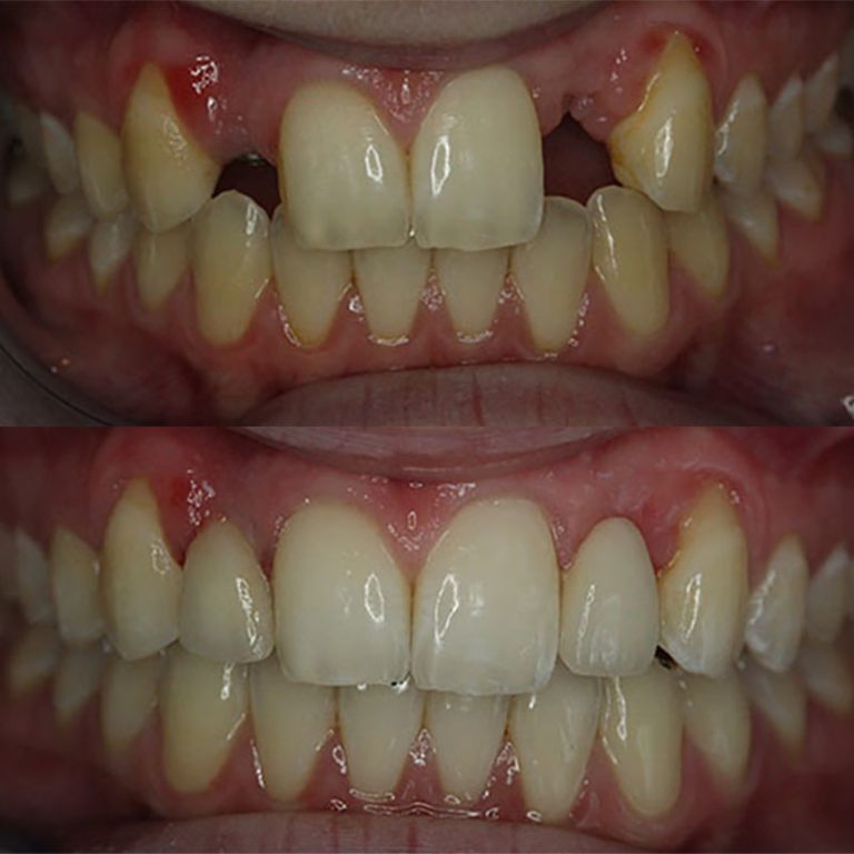 Front Tooth Dental Implants Manhattan Brooklyn Before After 768x768