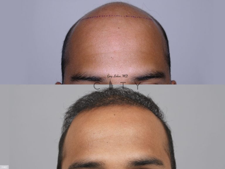 Hair Transplant F082 1024x768 1 768x576