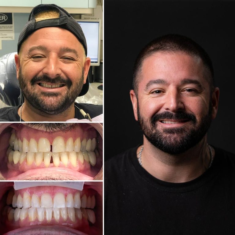 Invisalign before after 03 768x768