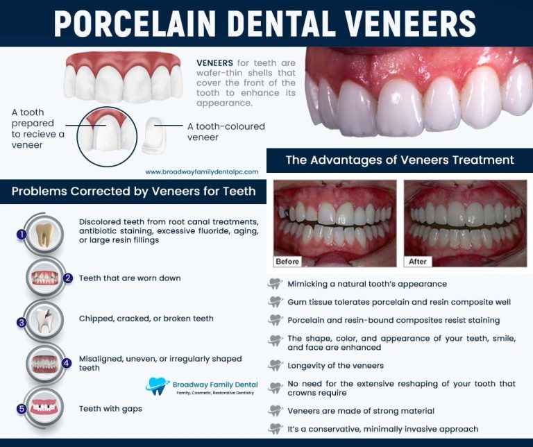 Porcelain Dental Veneers 768x644