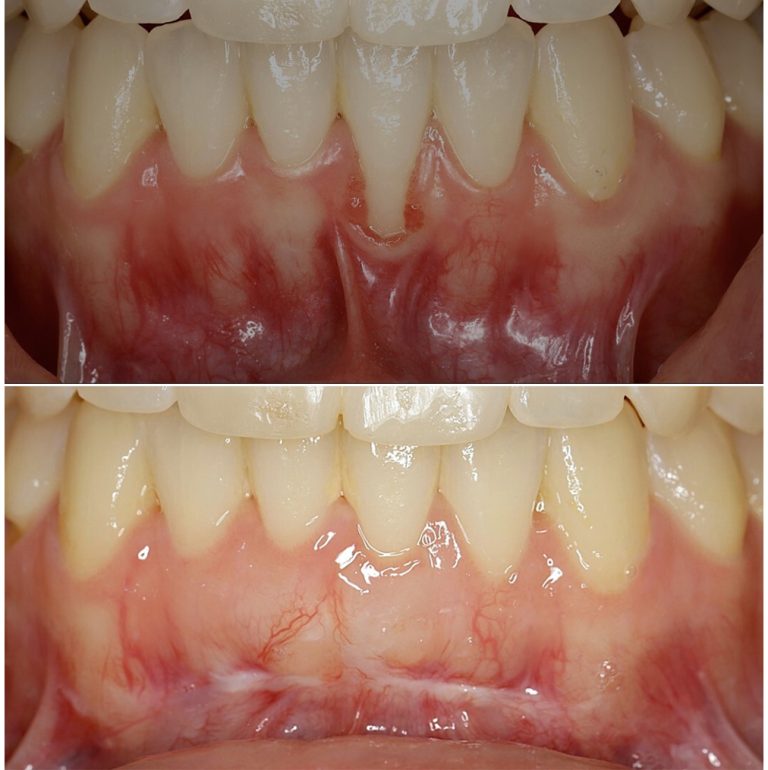 connective tissue graft before after 1 768x770