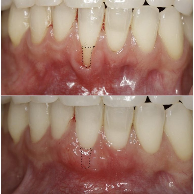 connective tissue graft before after 3 768x770