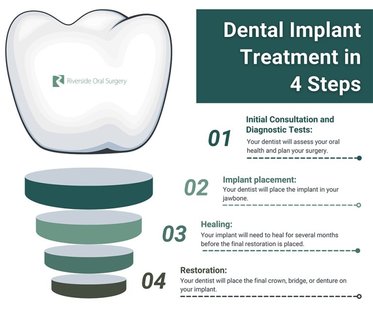 dental implant treatment in 4 steps 768x644