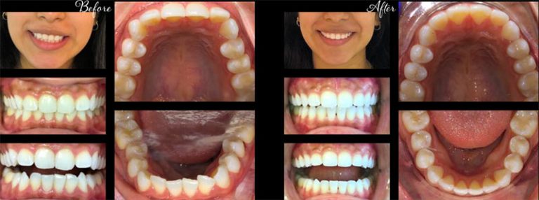 invisalign before after 1 768x286