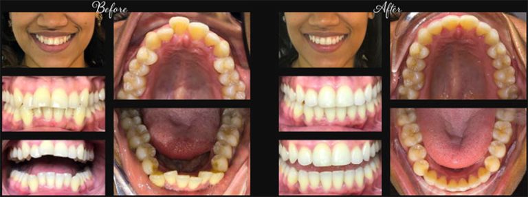 invisalign before after 2 768x287