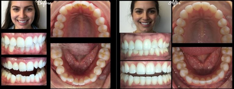 invisalign stamford ct before after2 768x292