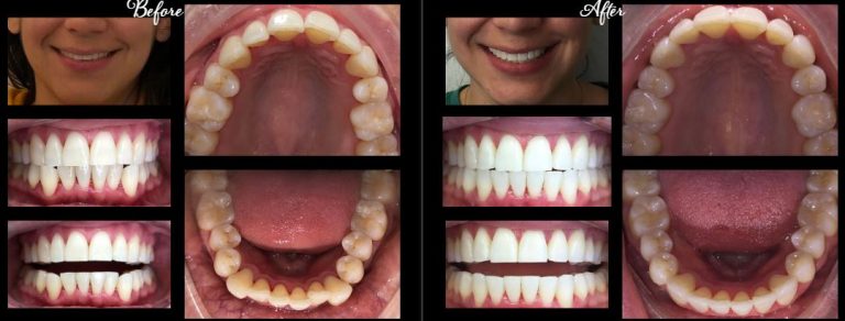 invisalign stamford ct before after3 768x292