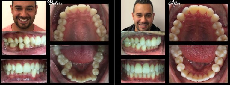 invisalign stamford ct before after4 768x284