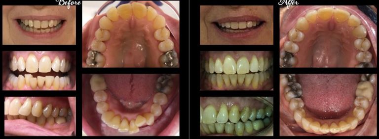 invisalign stamford ct before after5 768x283