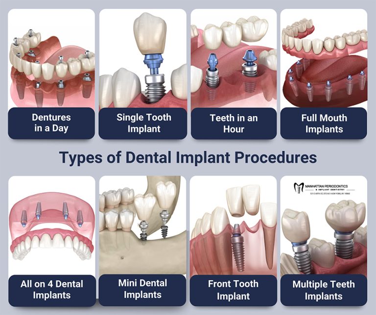 types of dental implant procedures 768x644