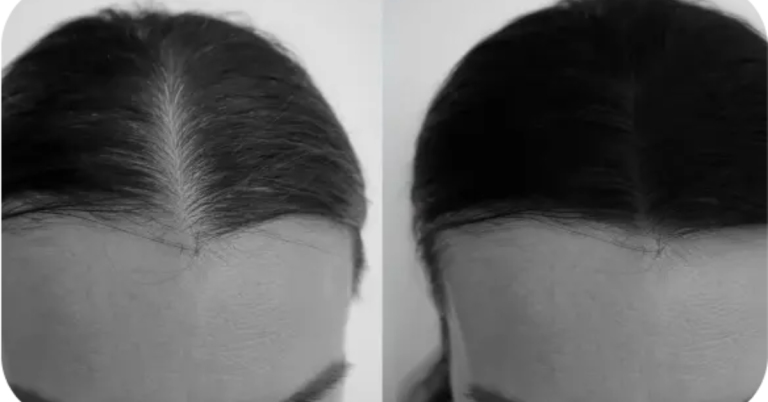 Best Hair Loss Treatment For Female 768x402