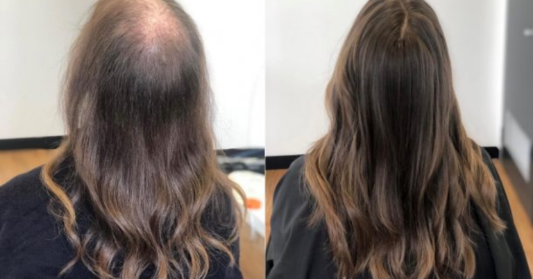 Best Hair Loss Treatment For Women 768x402