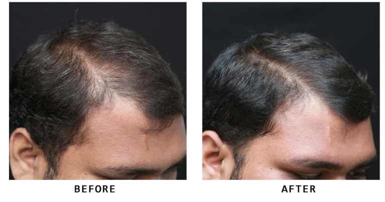 Hair Fall Specialist Near Me 768x402